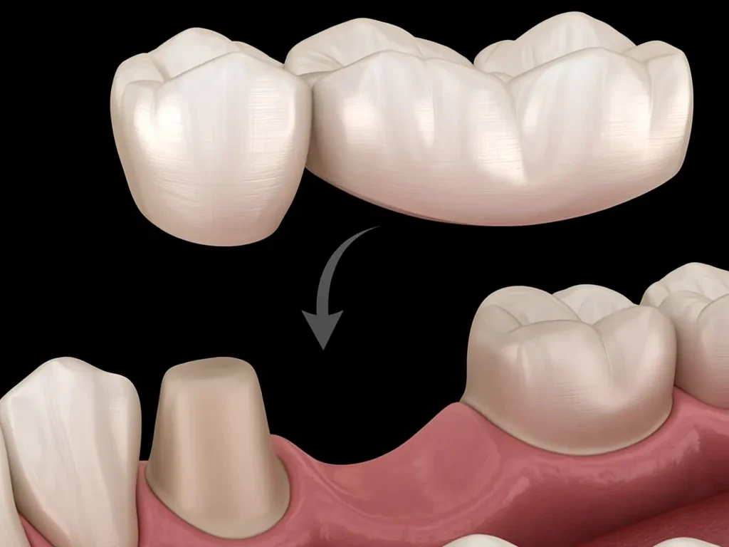Mosty protetyczne w Łukowie